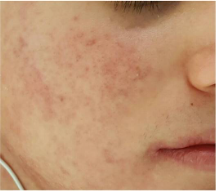 Después del tratamiento dermatológico del acné, caso clínico 02