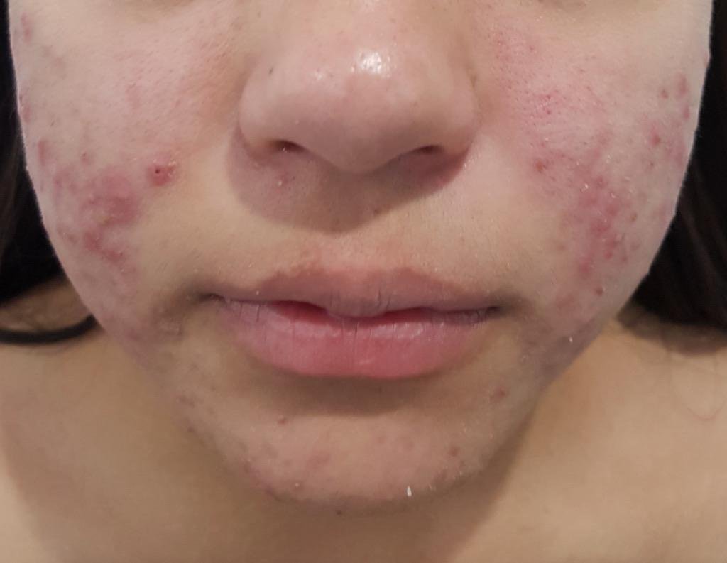 Antes del tratamiento dermatológico del acné, caso clínico 01