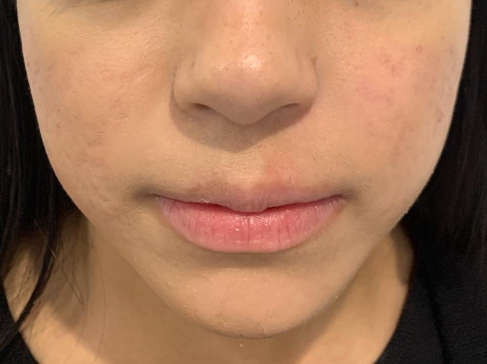 Después del tratamiento dermatológico del acné, caso clínico 01