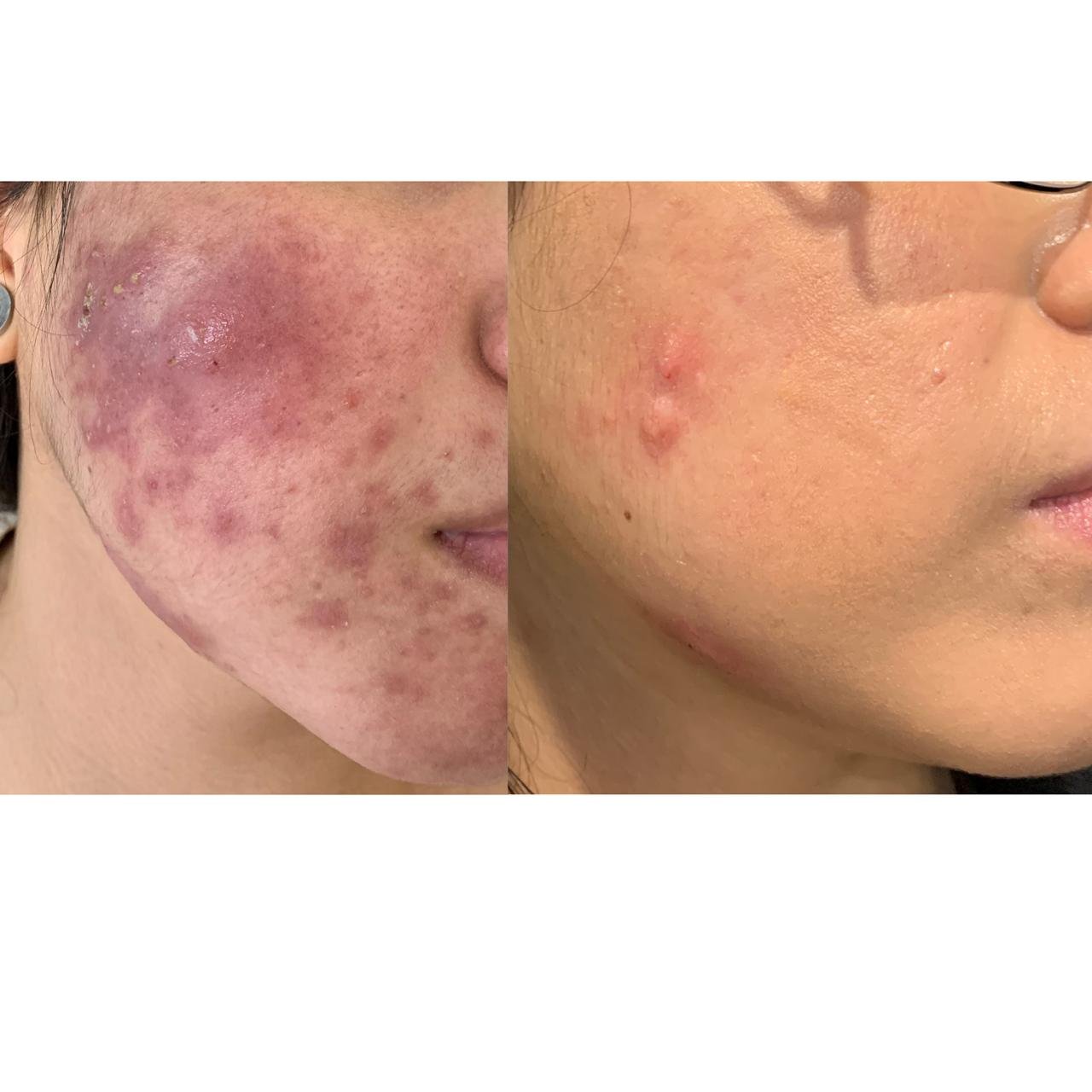 Comparación antes y después del tratamiento dermatológico, caso clínico 04