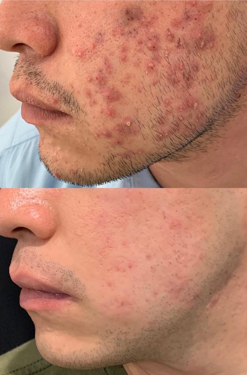 Comparación antes y después del tratamiento dermatológico, caso clínico 05
